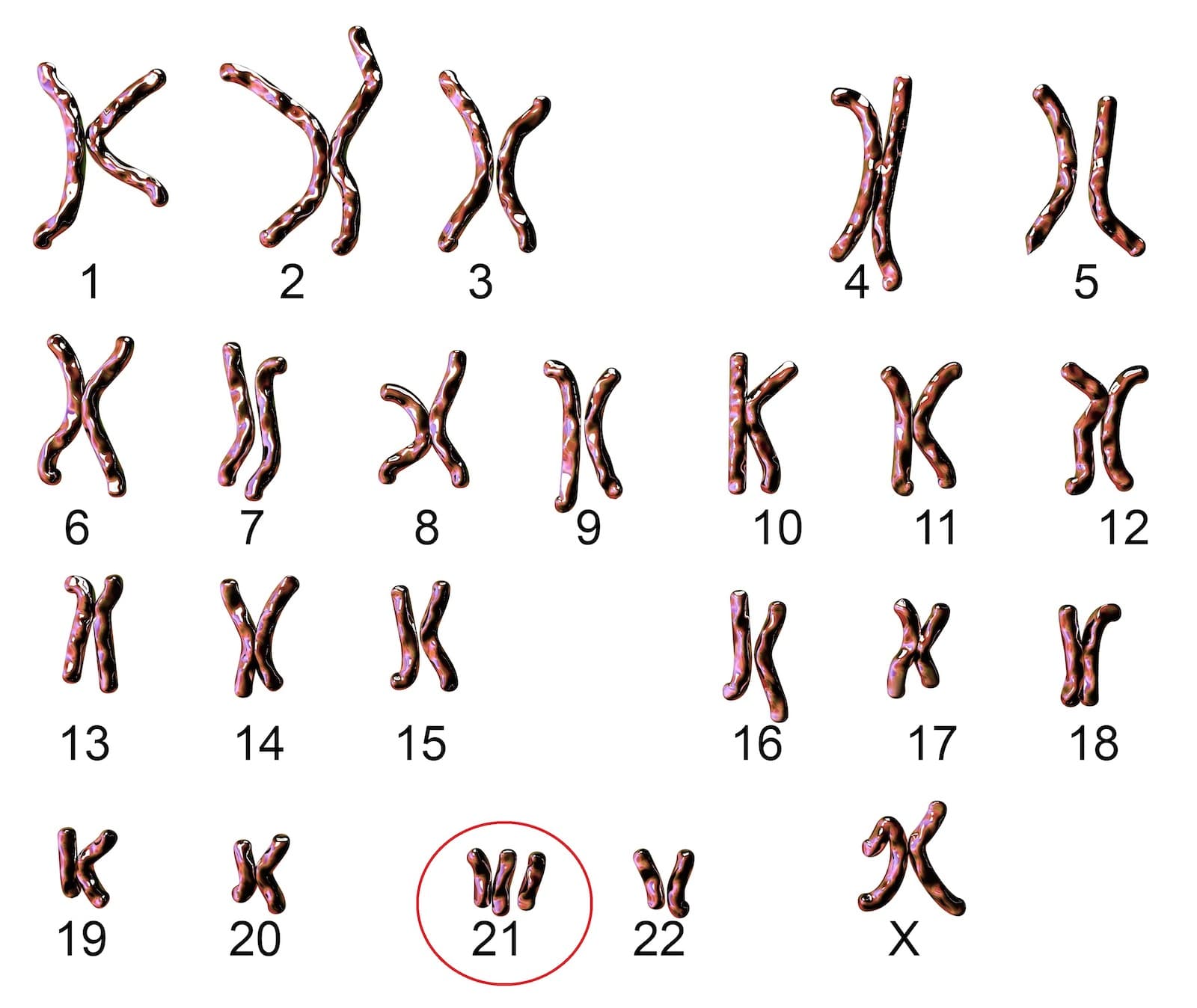 Down-szndróma kromoszómák
