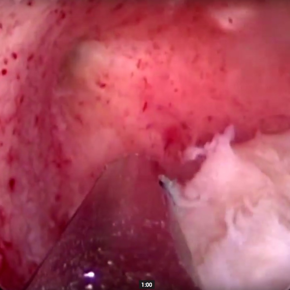 Merev hiszteroszkóp képe