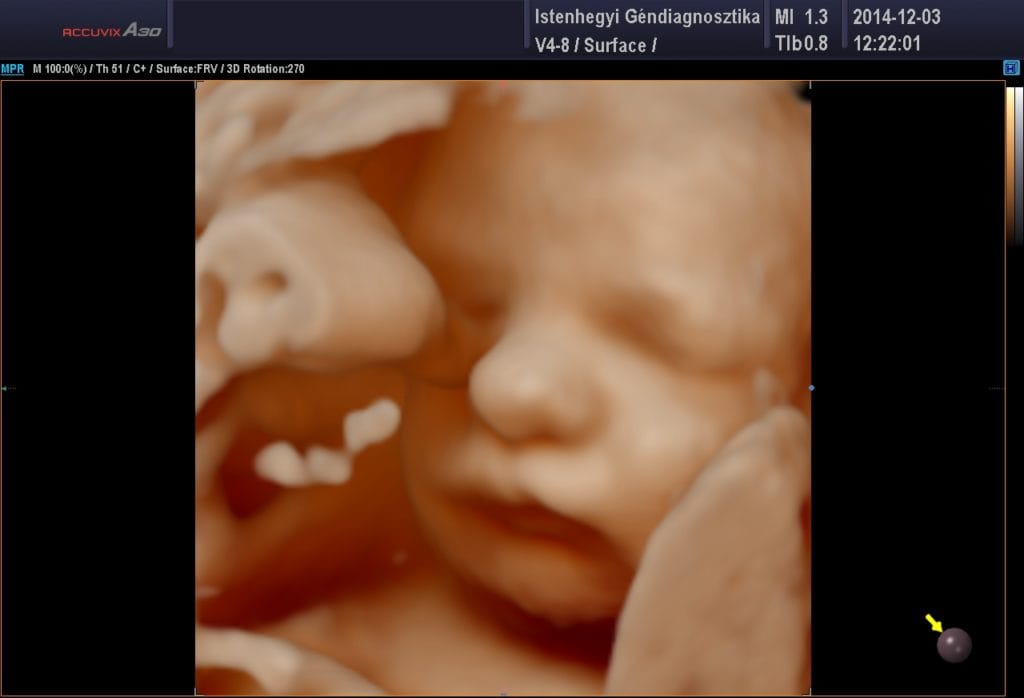 FRV 3D ultrahang felvétel