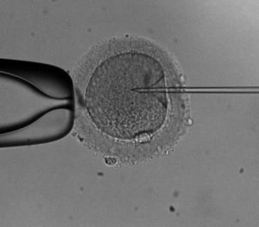 Intracitoplazmatikus spermium injekció (ICSI)