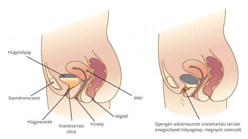 katéter utáni inkontinencia